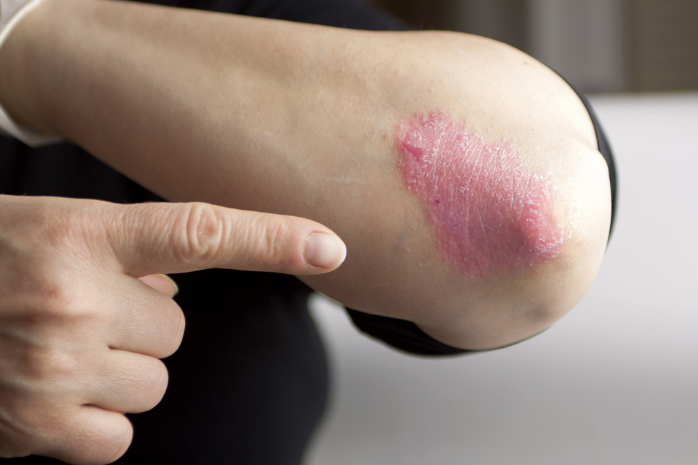 Laser Treatments for Psoriasis
