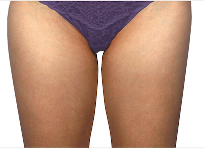 coolsculpting before inner thighs