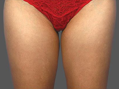 coolsculpting outer thighs before